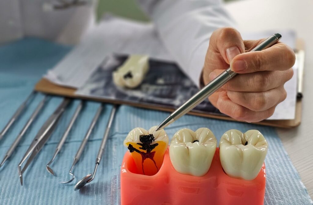 A dentist pointing to a dental model that shows how severe a cavity can become.